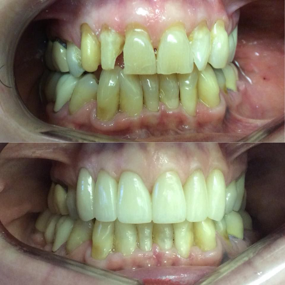upper-front-six-teeth-veneers